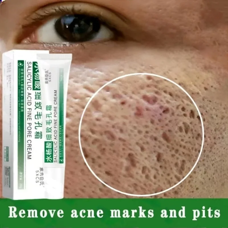 サリチル酸毛穴クリアリングクリーム毛穴を縮小黒ずみ除去にきび - Azelaic Acid Cream のレビューと価格