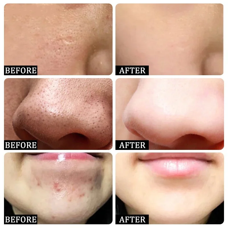 サリチル酸毛穴クリアリングクリーム毛穴を縮小黒ずみ除去にきび - Azelaic Acid Cream のレビューと価格