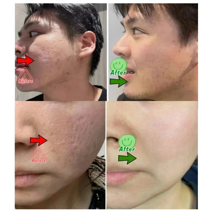 サリチル酸毛穴クリアリングクリーム毛穴を縮小黒ずみ除去にきび - Azelaic Acid Cream のレビューと価格