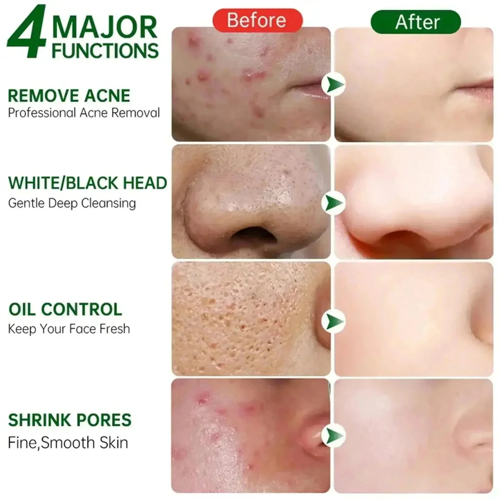 サリチル酸毛穴クリアリングクリーム毛穴を縮小黒ずみ除去にきび - Azelaic Acid Cream のレビューと価格