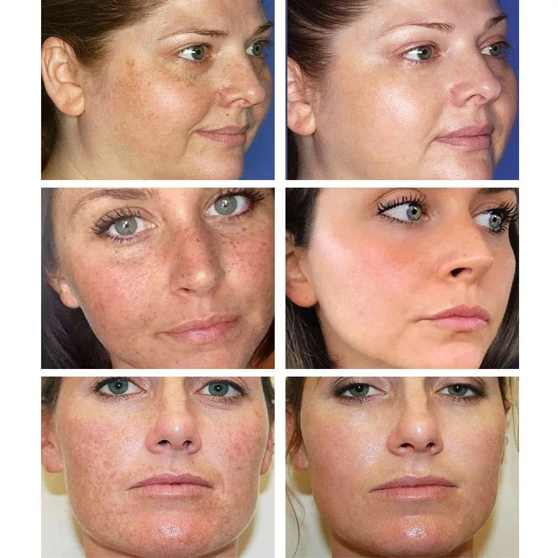 そばかすや色素沈着のための色素沈着のための美白クリーム,暗い - Skincare Glowing のレビューと価格