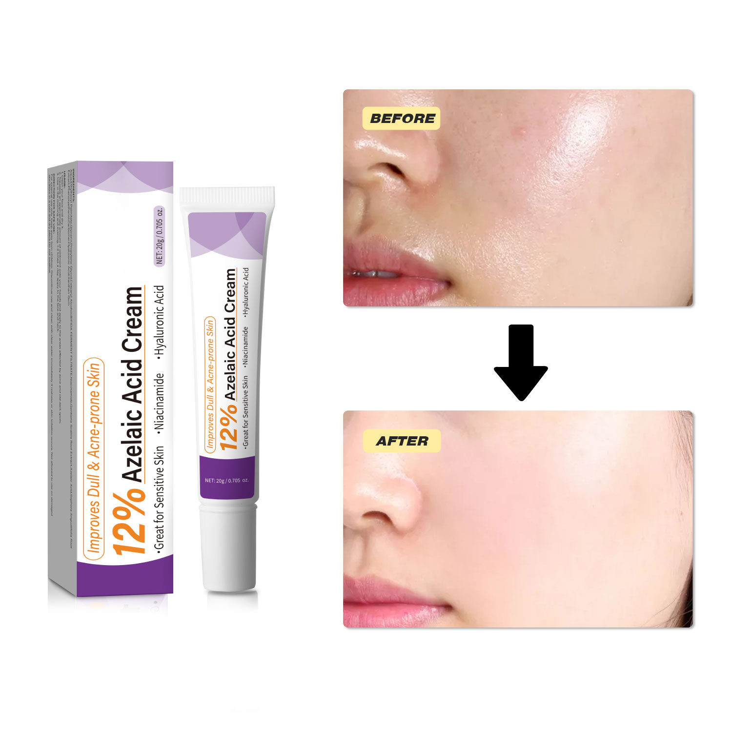 マイルドなアゼライン酸クリームは、くすんだ肌を改善し、荒れた - Azelaic Acid Cream のレビューと価格