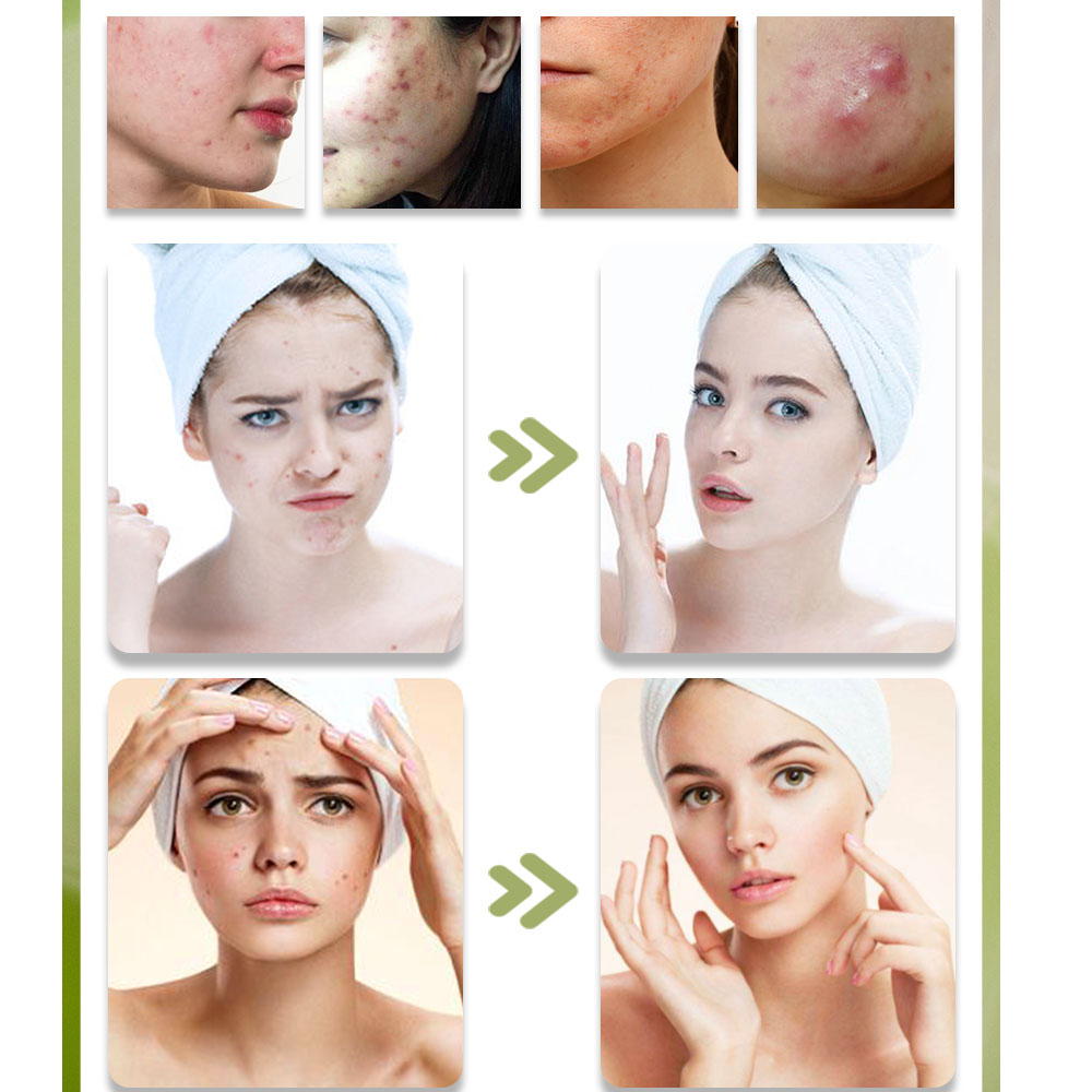 Kstims-にきび治療クリーム,美容液,そばかす,色素沈着 - Tea Tree Spot Treatment のレビューと価格